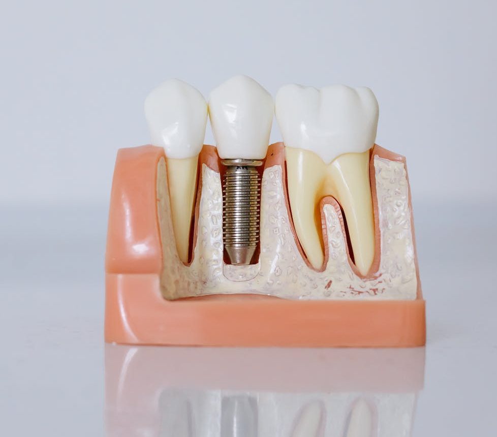 Impianti dentali