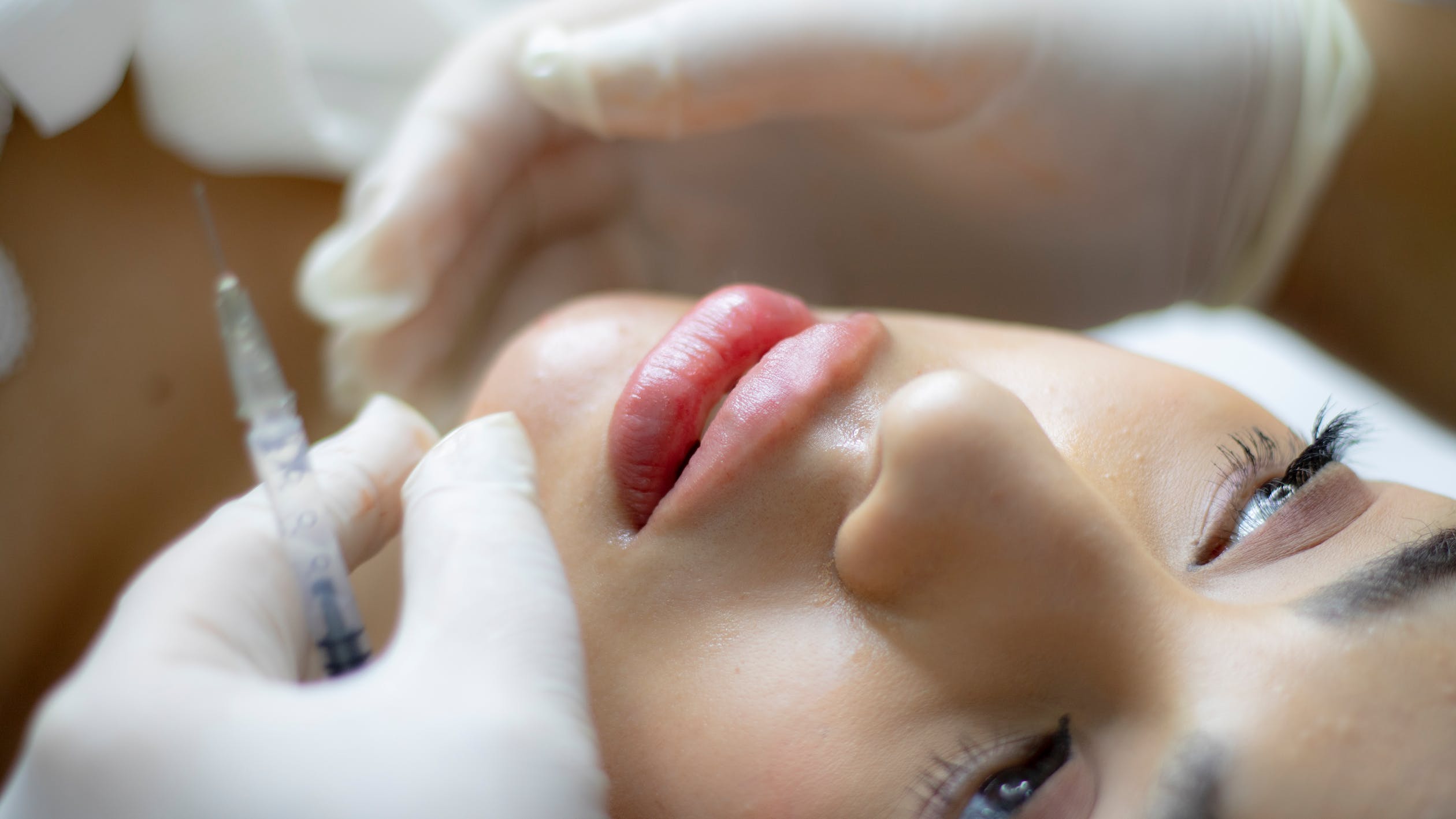 Filler Labbra
